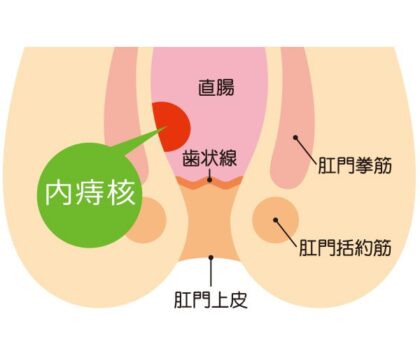 内痔核とは